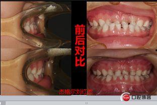 成人拔乳牙的视频播放,专业视频带你了解拔牙技巧与注意事项