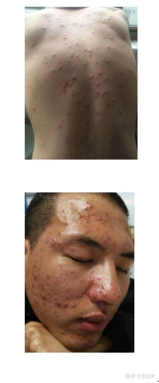 成人长水痘视频大全,视频大全带你了解症状与护理