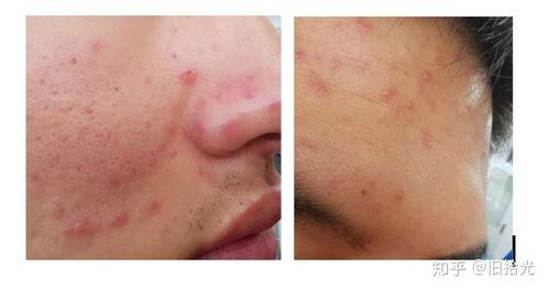 成人长水痘视频大全,视频大全带你了解症状与护理