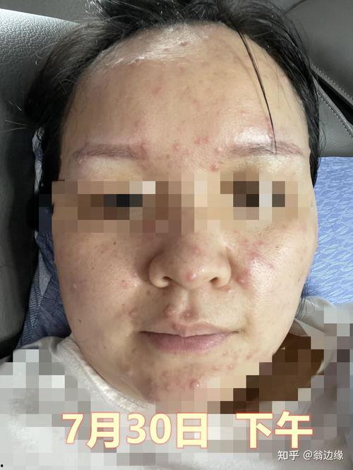 成人长水痘视频大全,视频大全带你了解症状与护理